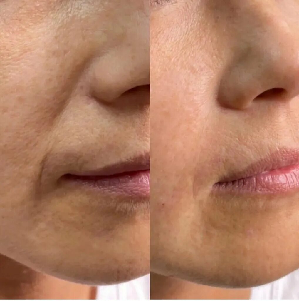 коррекция носогубных складок. филлеры в носогубные складки. гимнастика для лица фейсбилдинг. как подтянуть носогубные складки. упражнения для овала лица.