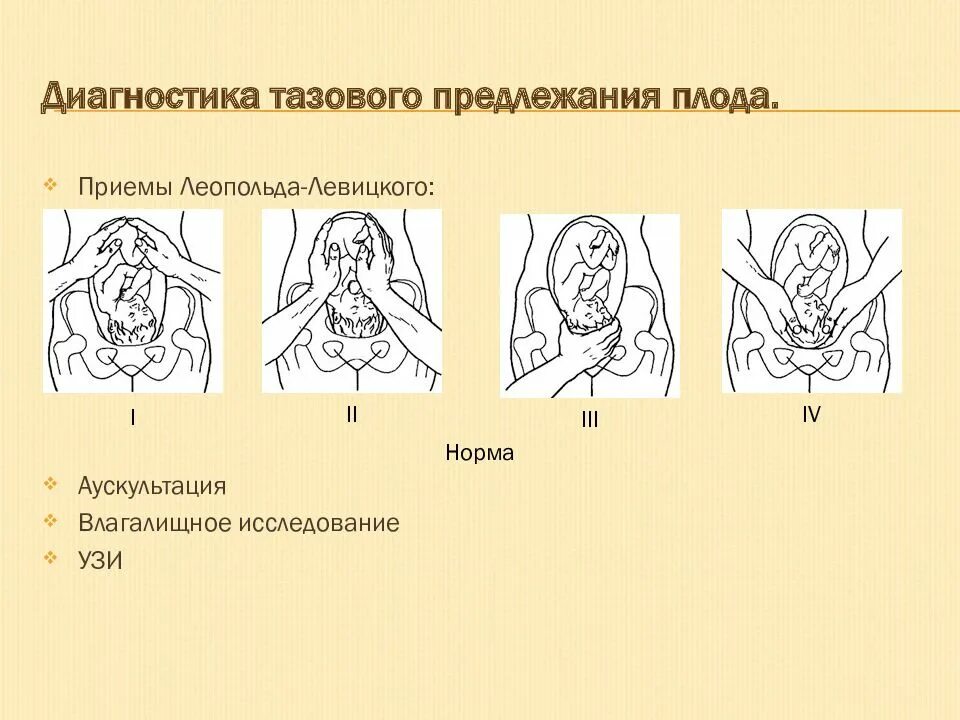 Тазовое предлежание плода на 20. Приемы наружного акушерского исследования Леопольда Левицкого. Четвертый прием Леопольда Левицкого. Тазовое предлежание приемы Леопольда. Акушерское исследование Леопольда Левицкого.