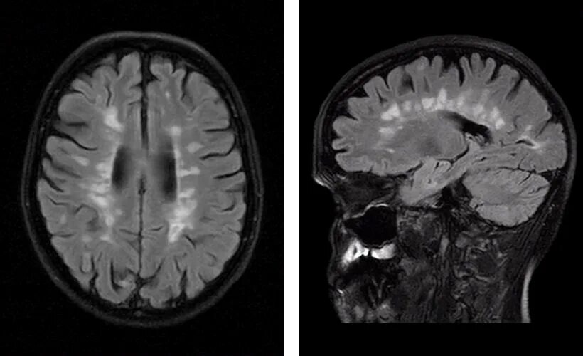 Пальцы Доусона на мрт. Мрт головного мозга снимки рассеянный склероз. Рассеянный склероз пальцы Доусона. Рассеянный склероз снимки мрт. Множественные очаговые изменения головного мозга