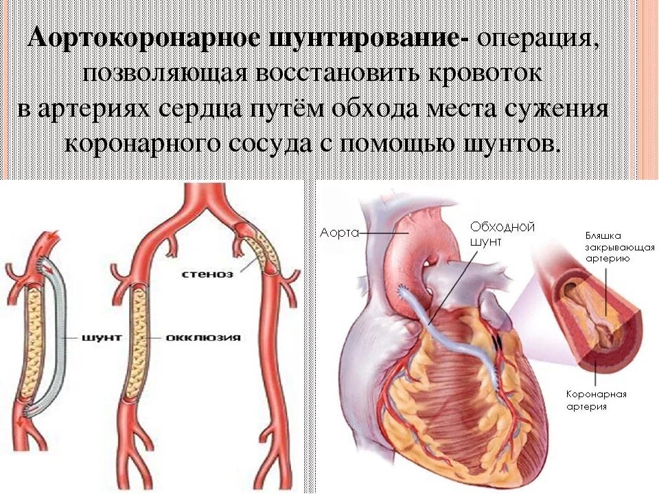 Операции коронарных артерий. Аортокоронарное шунтирование схема. Операция шунтирование сосудов сердца. Аутовенозное аортокоронарное шунтирование. Аортокоронарное шунтирование схема операции.