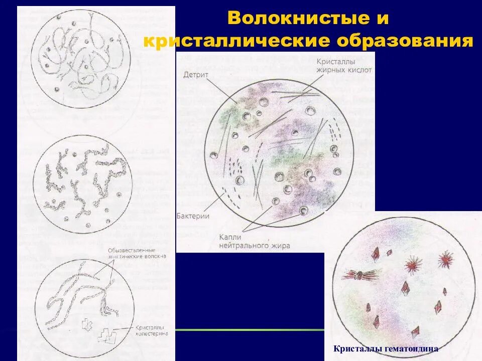 Кристаллы куршмана в мокроте. Кристаллические образования в мокроте. Волокнистые и Кристаллические образования в мокроте. Кристаллы гематоидина в мокроте. Кристаллы холестерина в мокроте.