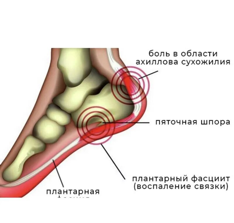 Почему болят сухожилия пятки. Фасциит плантарный фасциит. Подошвенный (плантарный) фасциит. Подошвенная пяточная шпора. Плацентарный фасциит стопа.