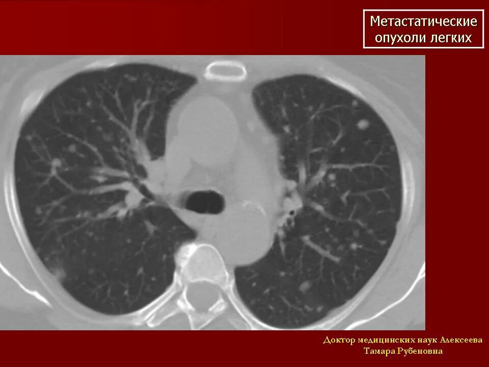 Кт картина метастатического поражения легких. Множественные метастазы в легких на кт. Метастатические опухоли легких.