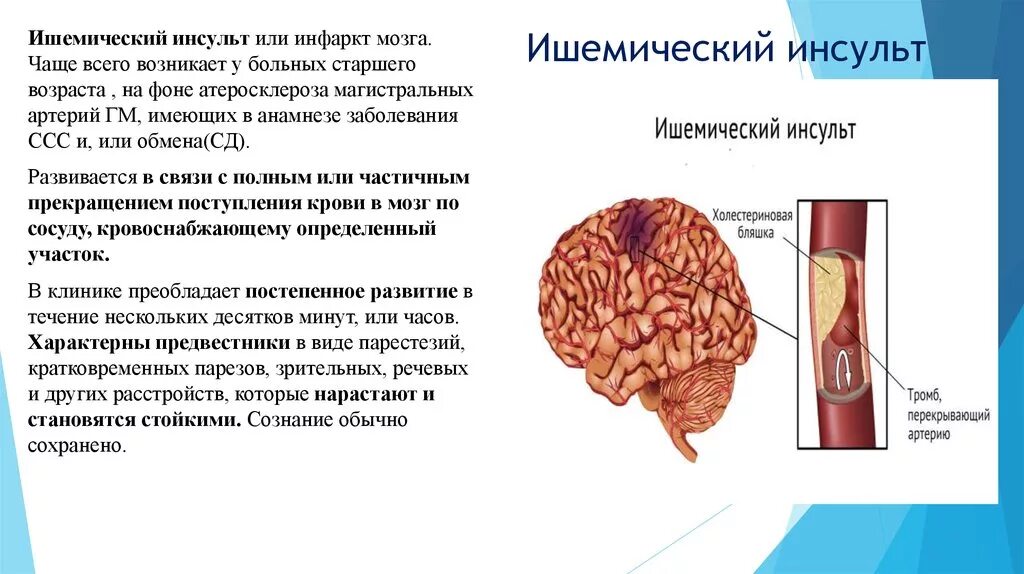 Чем отличается инфаркт от инсульта простыми. Инфаркт головного мозга классификация. Ишемический инсульт поражения артерий. Ишемический инсульт (инфаркт мозга). При ишемическом инсульте развивается.