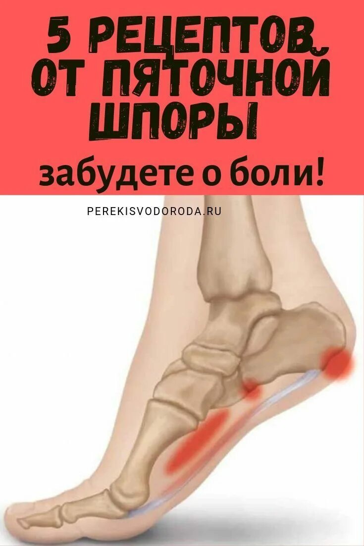 Картинки МОЖНО ЛИ ГРЕТЬ ПЯТОЧНУЮ ШПОРУ