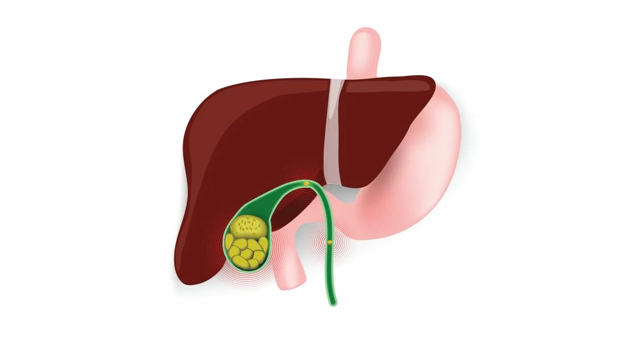 Желчный камень в кишечнике. Густая желчь в желчном пузыре. Печень и желчный пузырь.