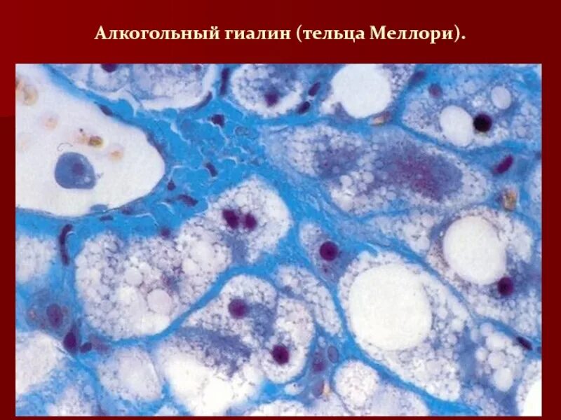 Тельца мэллори. .алкогольный гиалин (тельца маллори).. тельца маллори гистология.
