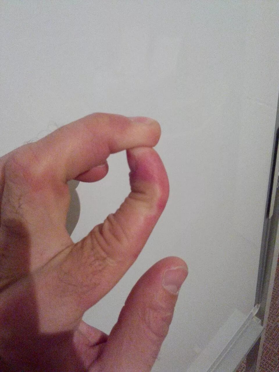 Проси не палец. Открытый перелом пальца. Перелом указательного пальца. Перелом пальца большого пальца.