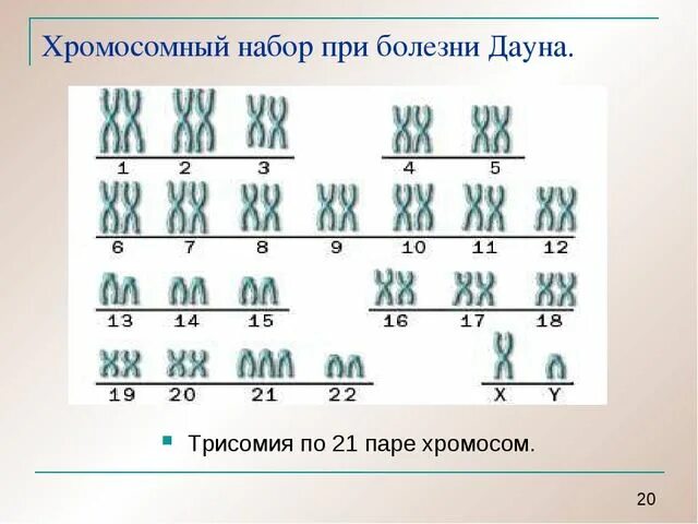 Схема хромосомного набора. Синдром Дауна трисомия 21 хромосомы. Синдром Дауна трисомия по 21 хромосоме. Синдром Дауна (трисомия по 21 паре хромосом). Синдром Дауна трисомия по 21-й хромосоме.