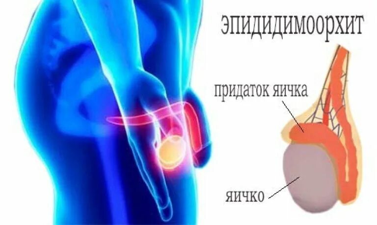 Воспаление придатка яичка. Воспаление придаткаяичек. Воспаление придатка яйца. Воспаление придатков яичка.