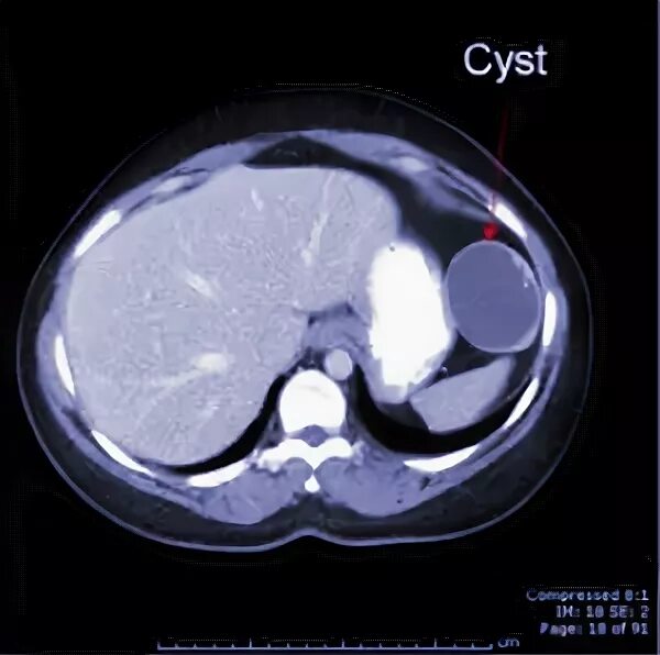 Киста селезенки лечение. Обызвествленная киста селезенки кт. Паразитарная киста селезенки на кт. Постинфарктная киста селезенки.