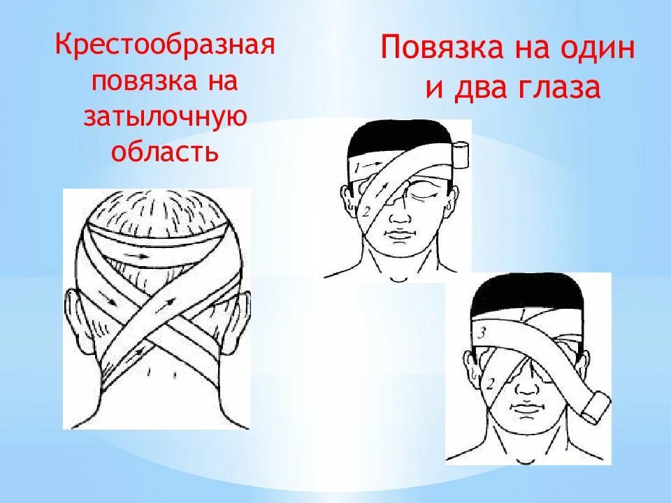 Повязки на голову шею. Десмургия восьмиобразная повязка. Колособразная повязка. Крестообразная повязка на голову. Крестообразная повязка на затылок.