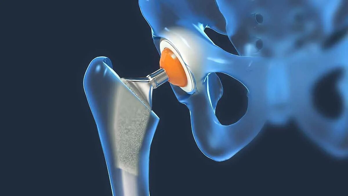 Тазобедренный эндопротез. Эндопротез шейки бедра. Протез тазобедренного сустава Zimmer. Биполярный эндопротез тазобедренного сустава. Замена сустава шейки бедра