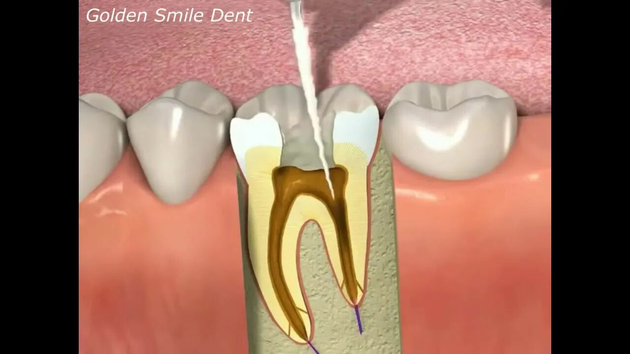 Распломбировка каналов зуба. Пломбирование каналов зубов. Отлом инструмента в канале зуба.