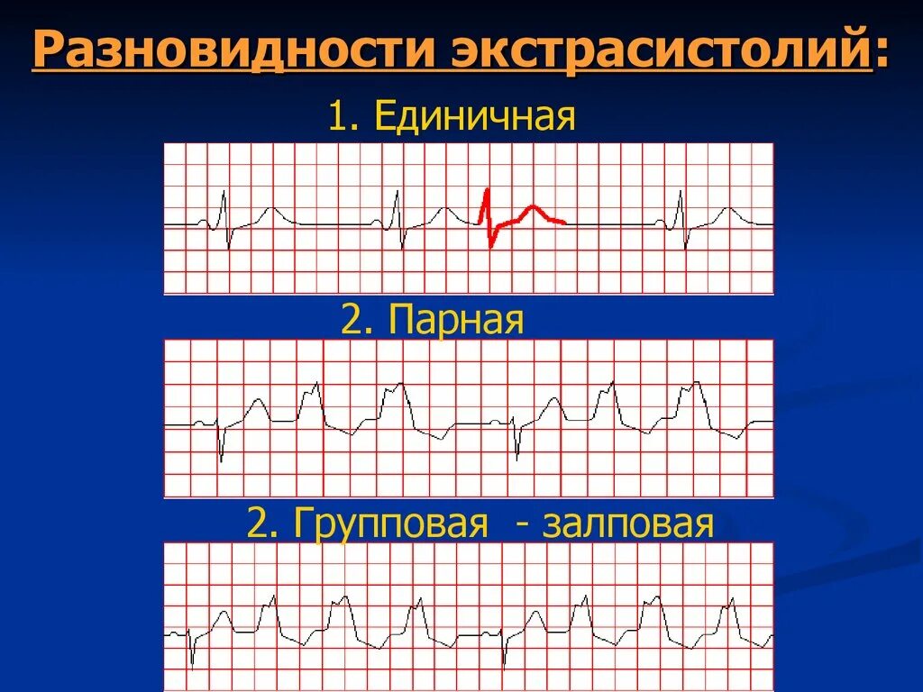 Как вылечить экстрасистолию