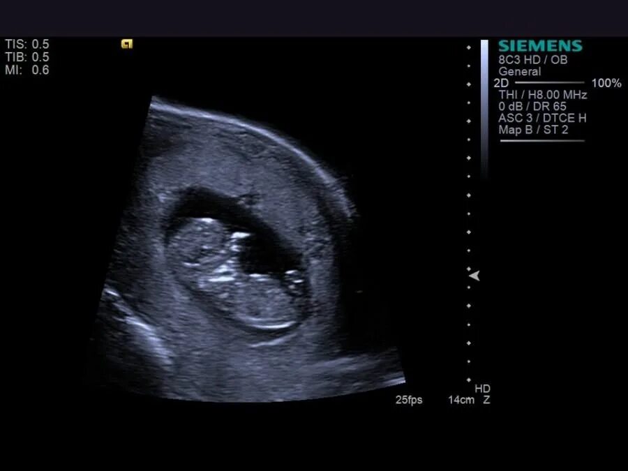 Размер плода акушерских недель. Плод 10 недель беременности фото размер плода. Эмбрион 10 недель беременности размер плода фото. Эмбрион на 10 неделе беременности УЗИ. Как выглядит эмбрион в 10 недель на УЗИ.
