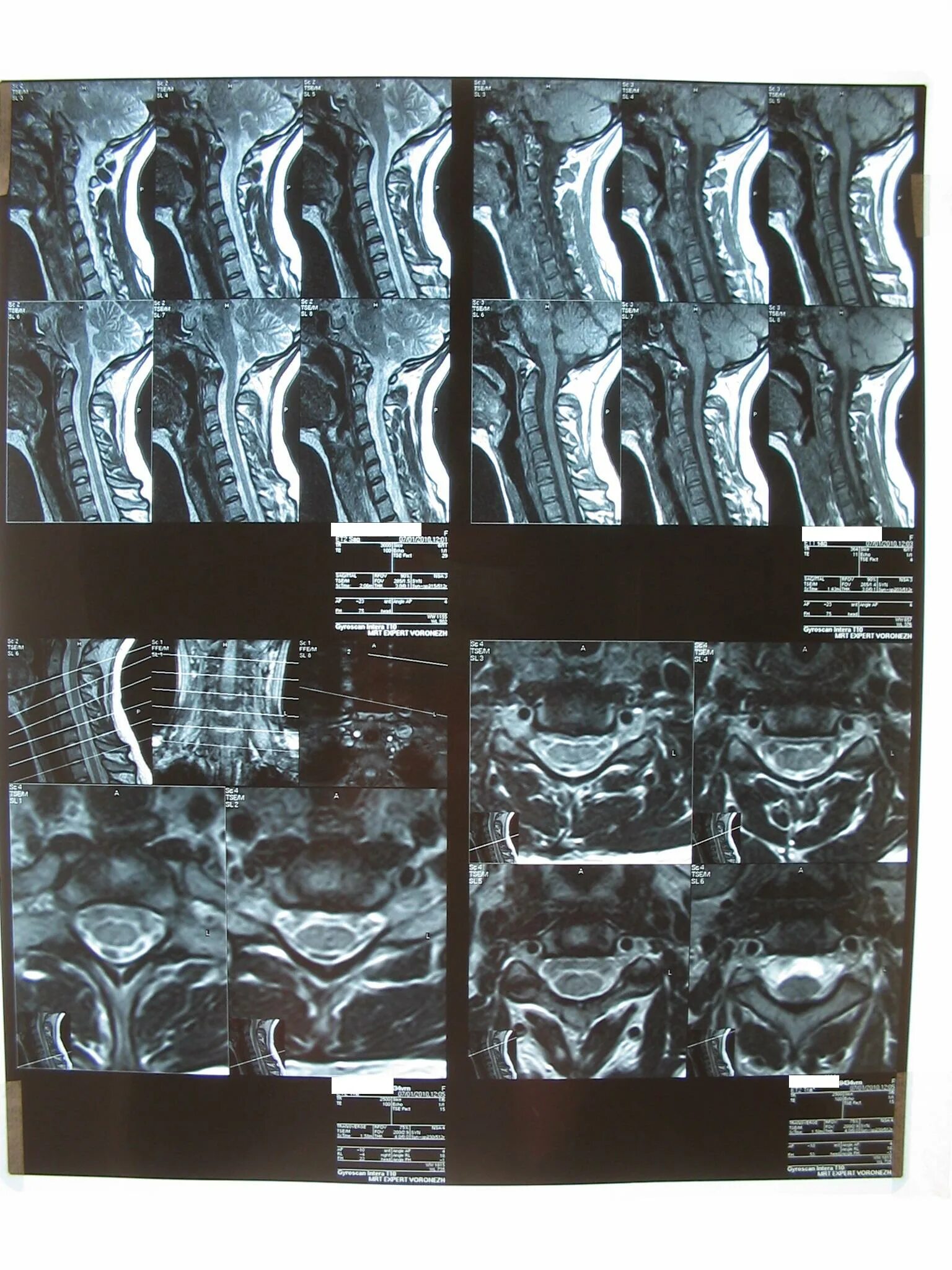 Мрт шейного отдела. Мрт шейного отдела позвоночника снимки. Реген мрт шейного отдела. Мрт шейного отдела позвоночника норма. Мрт шейного отдела позвоночника по времени