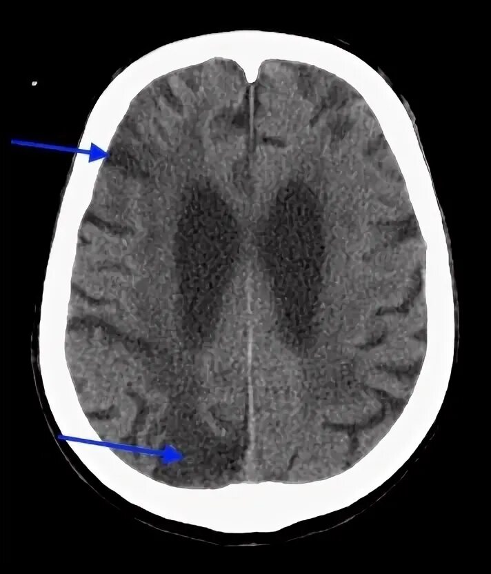 Единичный очаг в левой лобной доле. Очаги глиоза на кт. Лейкоареоз на кт. Глиоз мозга. Лейкоареоз головного мозга на кт.