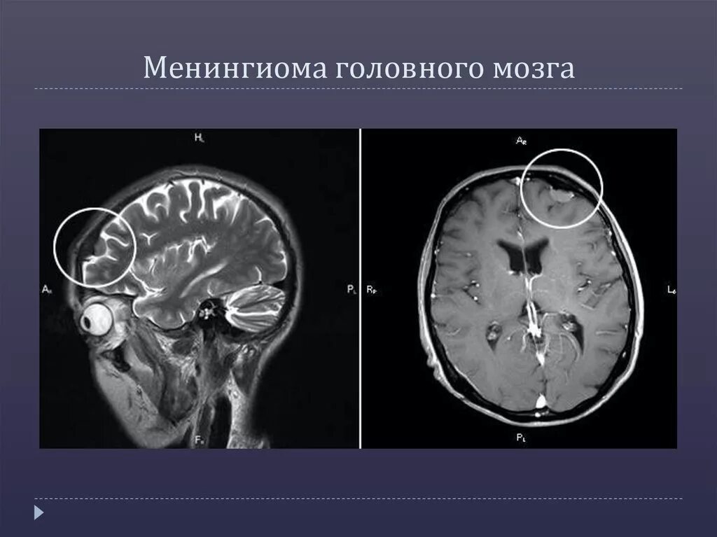 Менинготелиальная менингиома. СФЕНООРБИТАЛЬНАЯ менингиома. Субдуральная менингиома. Интракраниальная менингиома.