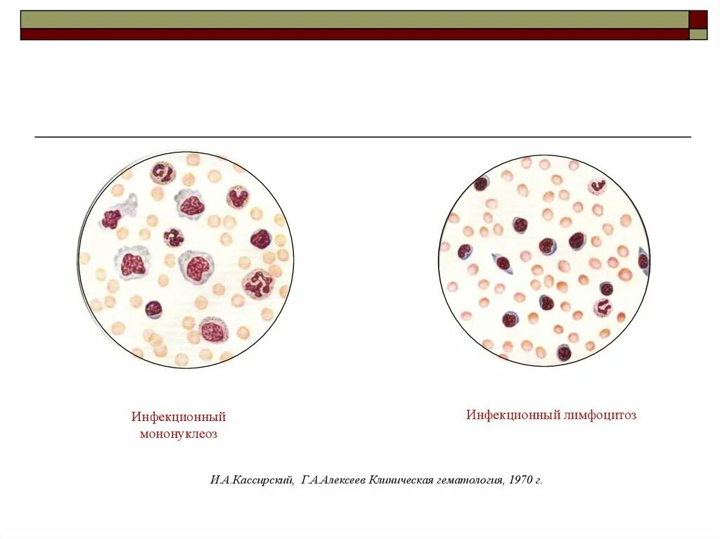 Моноуклеоз. Клиническая гематология Кассирский Алексеев 1970. Инфекционный мононуклеоз – возбудите. Морфология возбудителя инфекционного мононуклеоза. Инфекционный мононуклеоз рисунок.