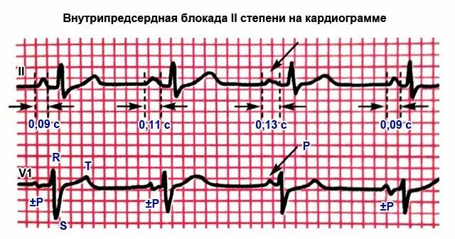 Что значит внутрипредсердная внутрипредсердная блокада. Внутрипредсердная блокада 2 степени на ЭКГ. Внутрипредсердная блокада 1 степени на ЭКГ что это такое. Внутрипредсердная блокада 3 степени ЭКГ. Полная внутрипредсердная блокада на ЭКГ.