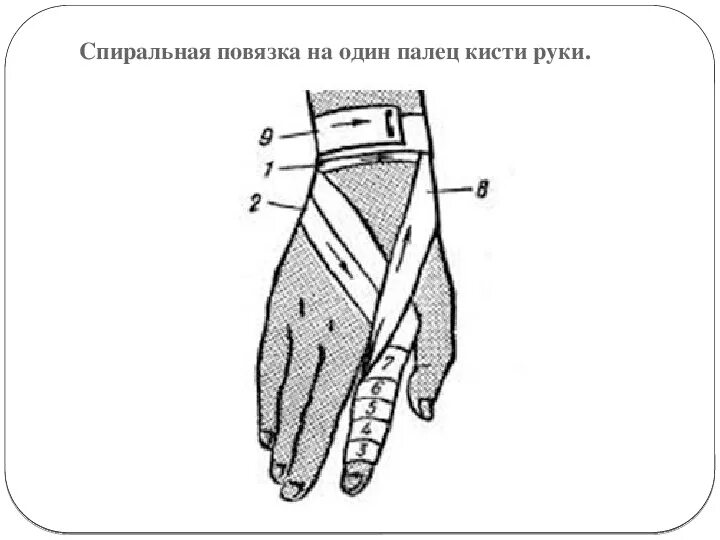 Спиральная повязка алгоритм. Спиральная повязка на палец. Спиральная повязка на один палец. Рыцарская перчатка повязка. Фиксирующая повязка на 1 палец кисти.