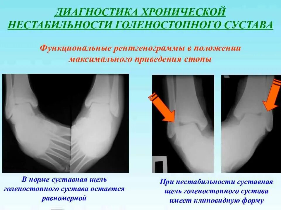 Нестабильность сустава голеностопа. Нестабильность голеностопного сустава рентген. Нестабильный сустав голеностопа. Нестабильность коленного сустава рентгенодиагностика.