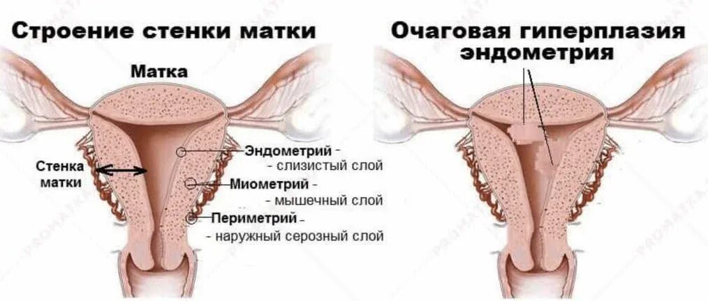 Эндометрий матки гиперплазия. Очаговая гиперплазия эндометрия матки что это. Разрастание эндометрия симптомы. Эндометрия матки симптомы лечение