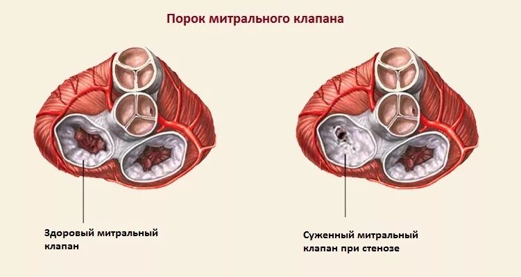 Митральный аортальный стеноз. Порог митрального клапана. Митральный стеноз макро. Порок митрального клапана сердца. Порок митрально аортального клапана.