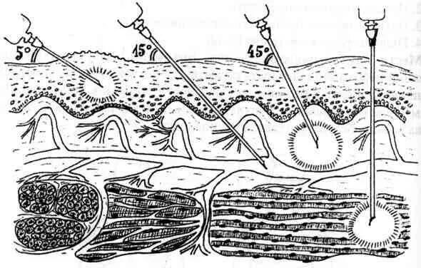 Внутривенно под каким углом. Угол введения иглы при внутрикожной инъекции. Внутримышечная внутривенная подкожная внутрикожная инъекция. Подкожная инъекция глубина введения иглы. Внутрикожная инъекция глубина введения иглы.