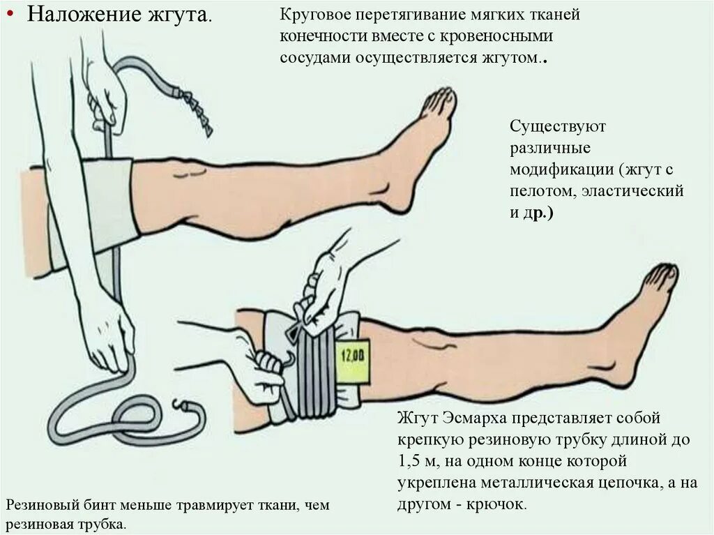 Сколько держать артериальный жгут. Наложение жгута Эсмарха при кровотечении алгоритм. Техника наложения жгута Эсмарха. Наложение артериального жгута Эсмарха. Техника наложения жгута Эсмарха при артериальном кровотечении.