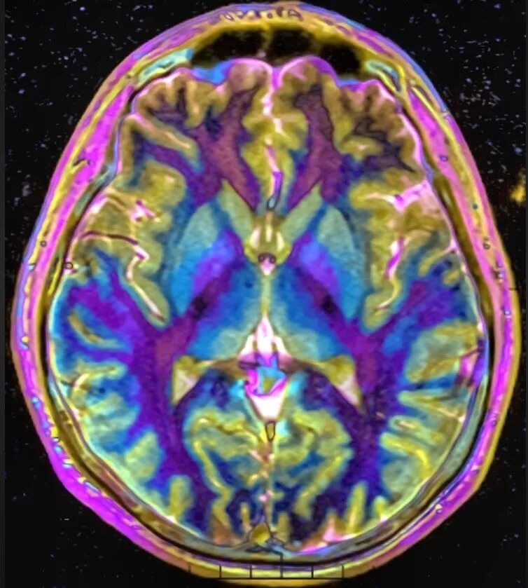 Мрт с контрастом головного. Мрт головного мозга с контрастированием. Мрт картирование головного мозга. ЯМРТ С контрастированием. Мрт с контрастом.