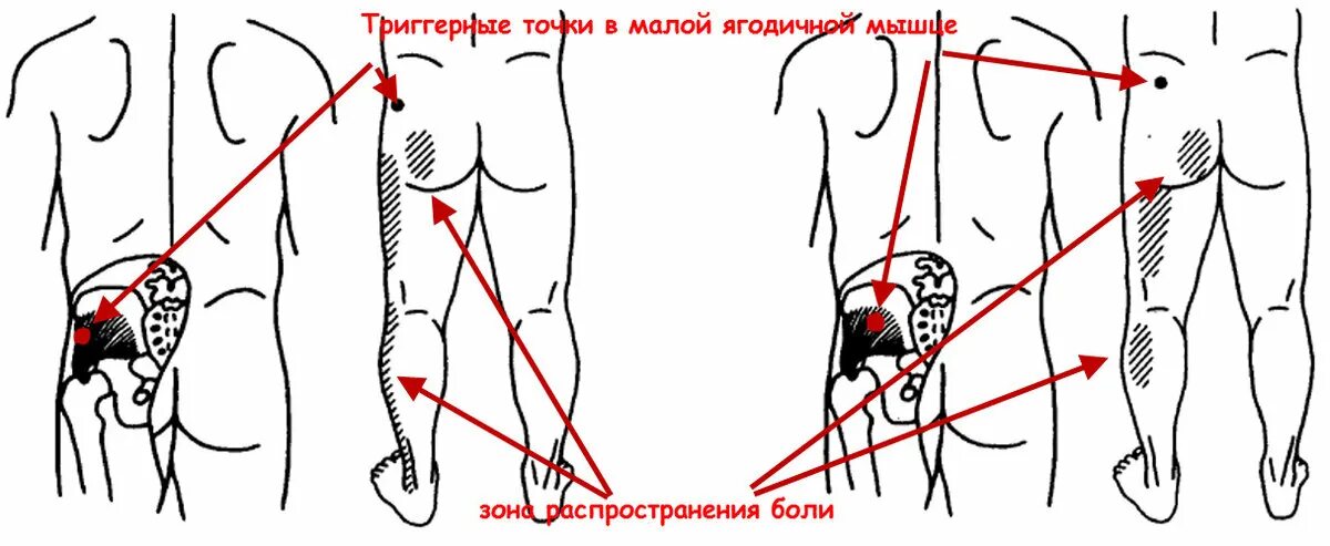 Триггерные точки ягодичной мышцы.