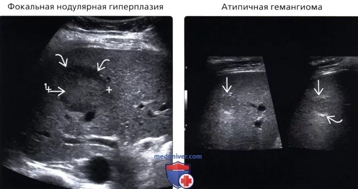 Фокальная Узловая гиперплазия печени на УЗИ. Нодулярная гиперплазия печени на УЗИ. Узловая гиперплазия печени на УЗИ. Нодулярная Узловая гиперплазия печени.