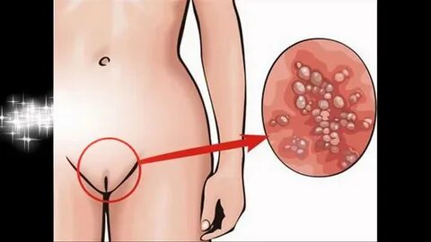 โ ร ค ห น อ ง ใ น - YouTube