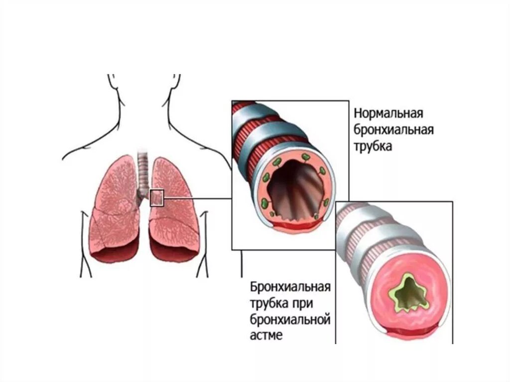 Спадение бронха