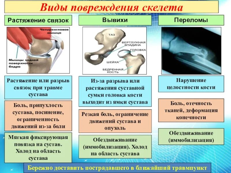 Сотрясение кости. Растяжение связок перелом вывих ушиб типы травм. Таблица типы повреждений симптомы первая помощь перелом. Таблица виды травм первая помощь и симптомы растяжение перелом. Отличие перелома от растяжения.