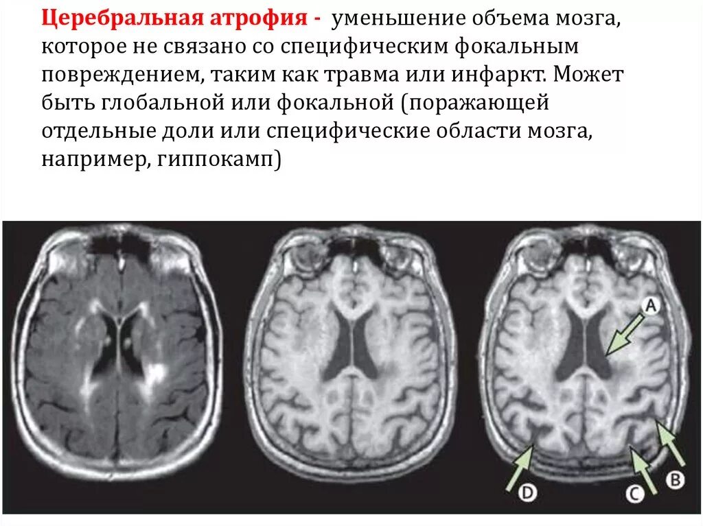 Атрофия головного мозга продолжительность. Атрофические изменения коры головного мозга. Атрофические изменения головного мозга кт признаки. Атрофические изменения коры головного мозга причины. Кт признаки церебральной атрофии.