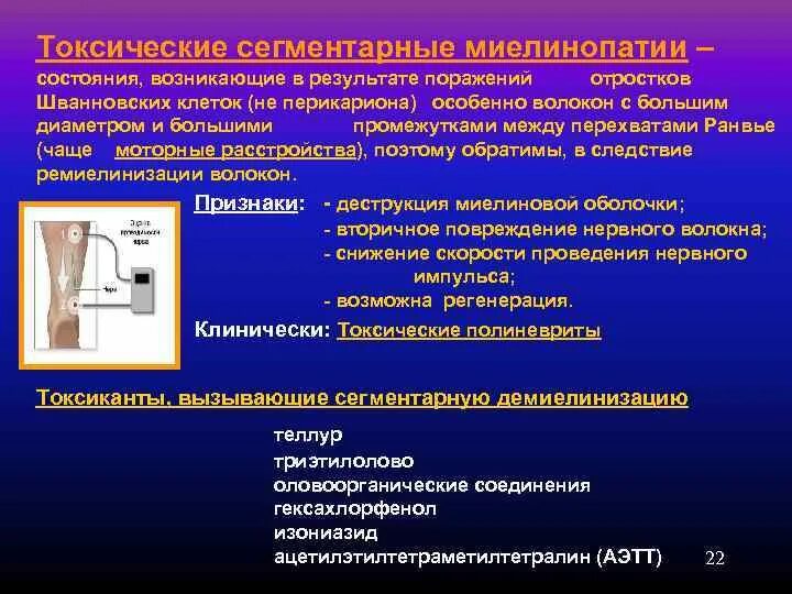 Аксональные и демиелинизирующие полинейропатии. Сенсорная форма полинейропатии. Полинейропатия диагноз. Аксональные и демиелинизирующие полинейропатии. Аксональные и демиелинизирующие полинейропатии.