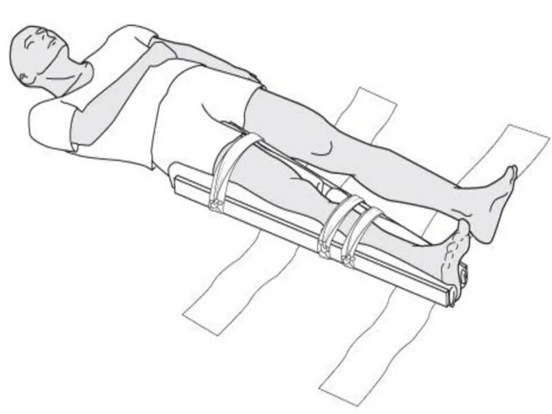 Перелом голени транспортировка. Иммобилизация большеберцовой кости. Иммобилизация при переломе большеберцовой кости. Наложение шины при переломе ноги. Наложение шины на ногу при переломе голени.