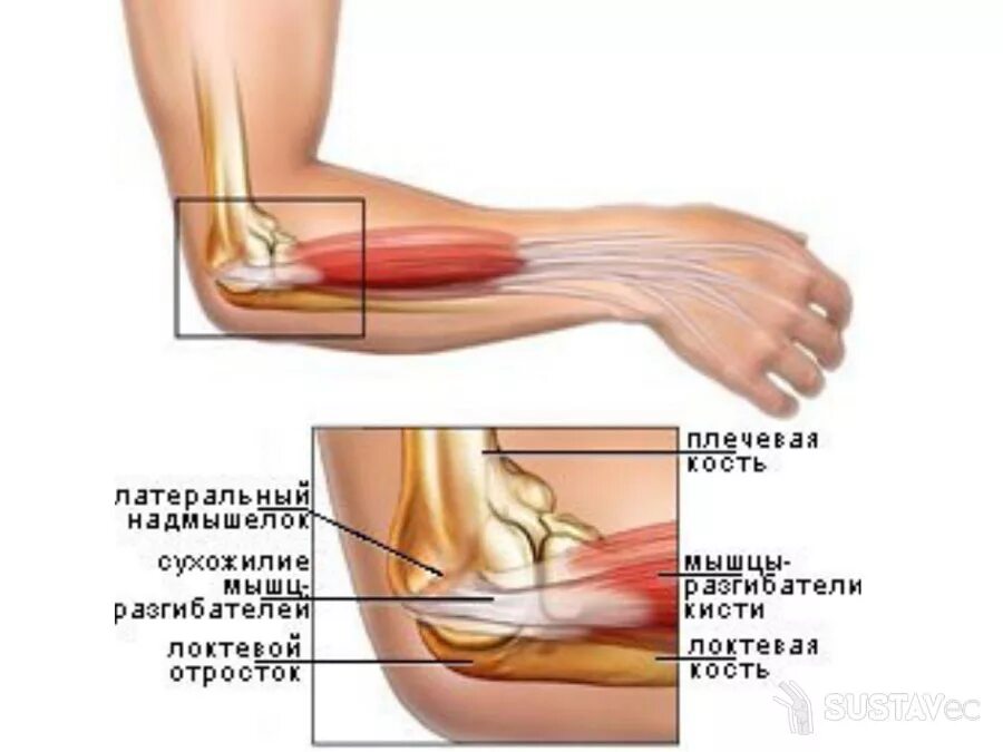 Боль в локте какой врач. Латеральный эпикондилит анатомия. Бурсит локтевого отростк. Повреждение сухожилия локтевого сустава. Медиальный надмыщелок локтевого сустава анатомия.