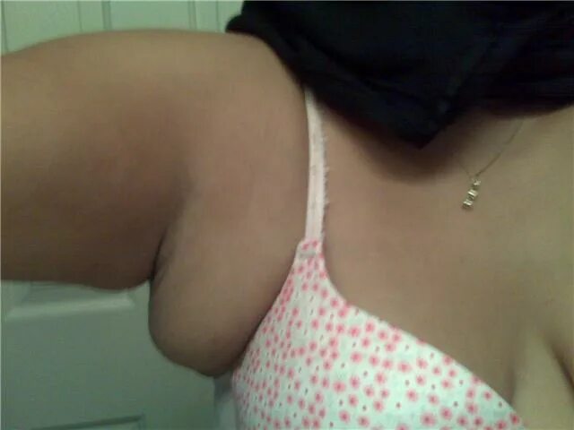 Добавочные молочные железы. Удаление добавочных молочных желез. Добавочные дольки молочных желёз. Удаление добавочных молочных желез. Удаление добавочных молочных желез.