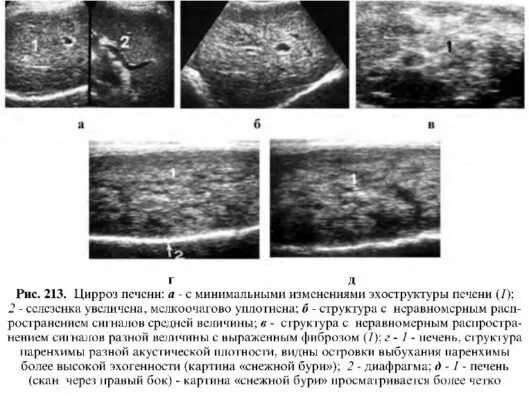 Пониженная эхогенность печени. УЗИ картина цирроза печени протокол. Цирроз печени на УЗИ описание. При циррозе паренхима печени на УЗИ протокол.