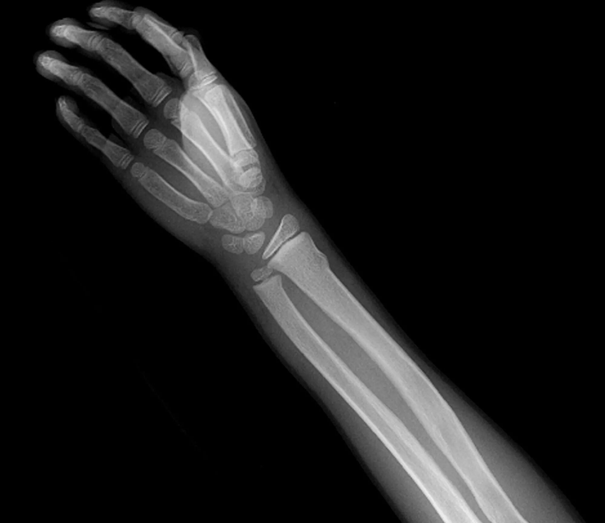 Рентгенограмма перелом кости. Лучевая кость на руке рентген перелом. Перелом лучевой кости рентген. Рентген перелома лучевой кости руки.