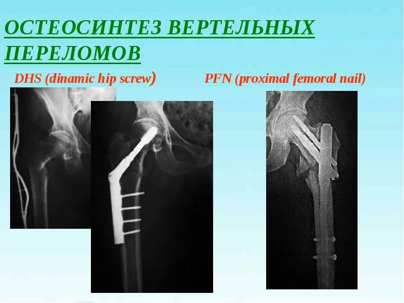 Остеосинтез проксимальный отдел. Чрезвертельный перелом шейки бедра. DHS остеосинтез чрезвертельный перелом. Шейка бедра перелом остеосинтез. Осложнения остеосинтеза