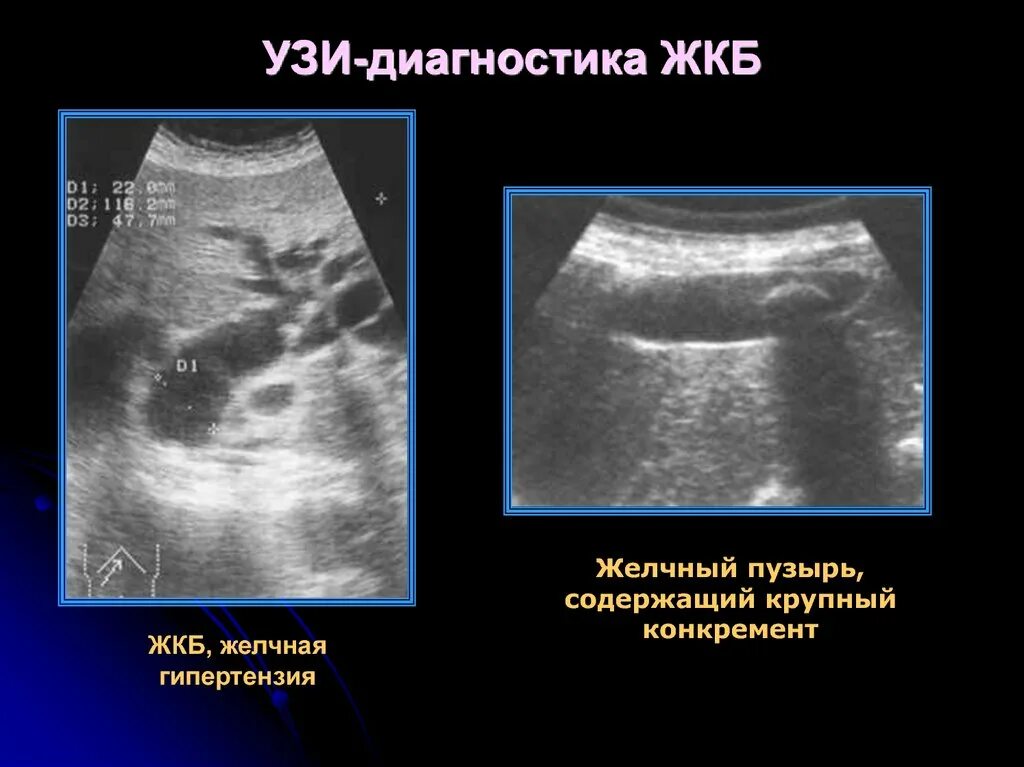 Диагностика жкб. УЗИ желчного пузыря желчекаменная болезнь. УЗИ брюшной полости ЖКБ про. УЗИ желчного пузыря желчнокаменная болезнь.