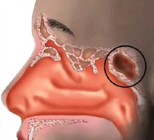 Сфеноидит воспаление клиновидной пазухи. Хронический сфеноидит симптомы. Сфеноидальная пазуха носа. Клиновидная пазуха носа воспаление.