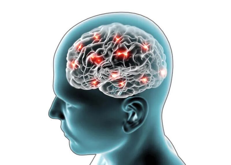 Ишемия головного мозга снимок. Инсульт иллюстрация.