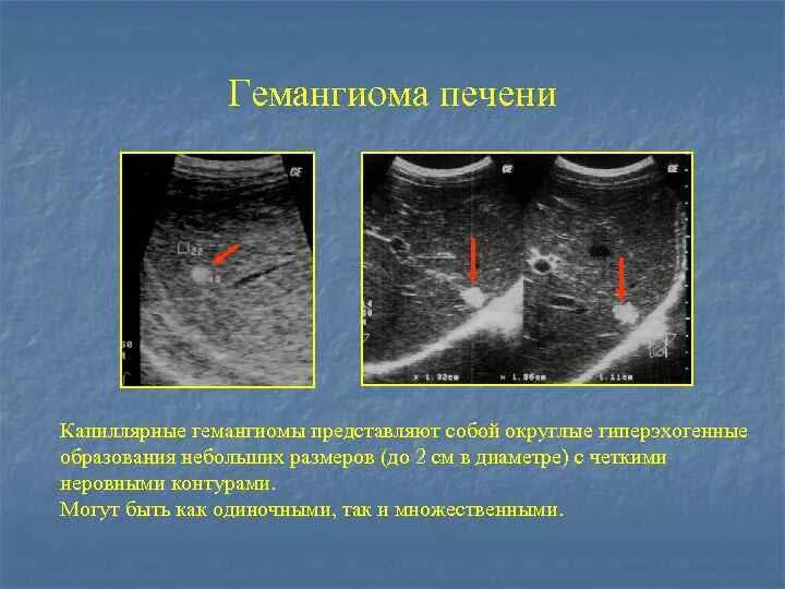 Округлые образования печени. УЗИ картина кавернозной гемангиомы печени. Капиллярная гемангиома печени на УЗИ. Гиперэхогенное образование в печени по УЗИ. Васкулярная опухоль печени.