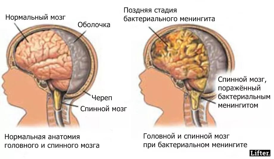Инфекционные поражения мозга. Менингит энцефалит и менингоэнцефалит. Менингоэнцефалит, воспаление головного мозга. Менингит мозговой бактериальный. Бактериальный менингоэнцефалит головного мозга у детей.